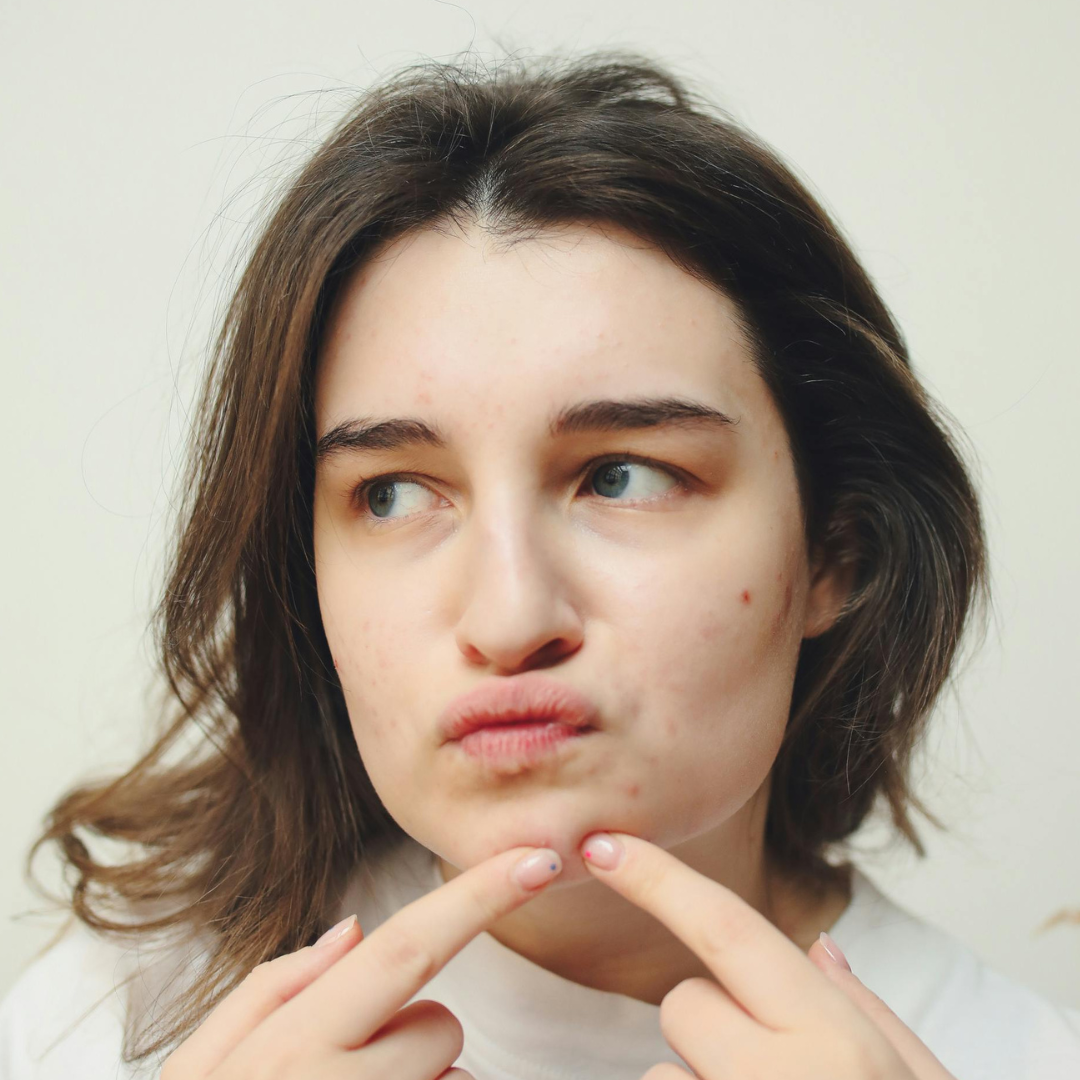 Why Your Acne Is Taking So Long to Heal — And What's Actually Happening Under the Surface